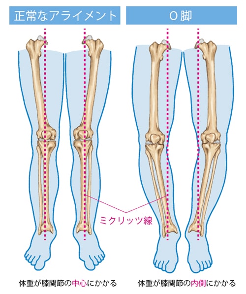 O脚で膝にかかる負担